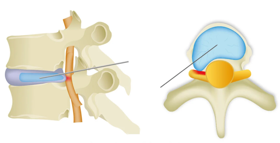 椎间盘内插入注射针